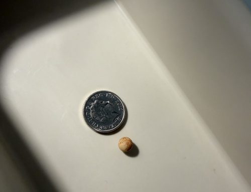Foreign Bodies Removed From Ears